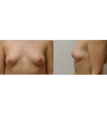 Before Breast Augmentation